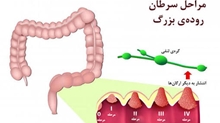  غربالگری سرطان روده بزرگ؛ توقف سرطان قبل از شروع